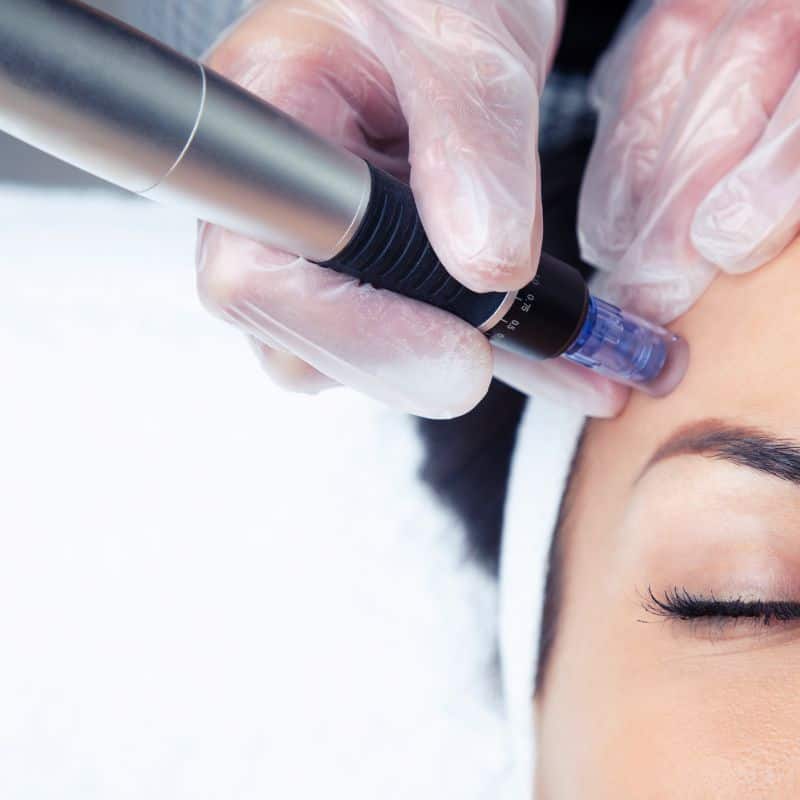 Morpheus8 treatment Harlow from Lipo Sculpt - Book in today!